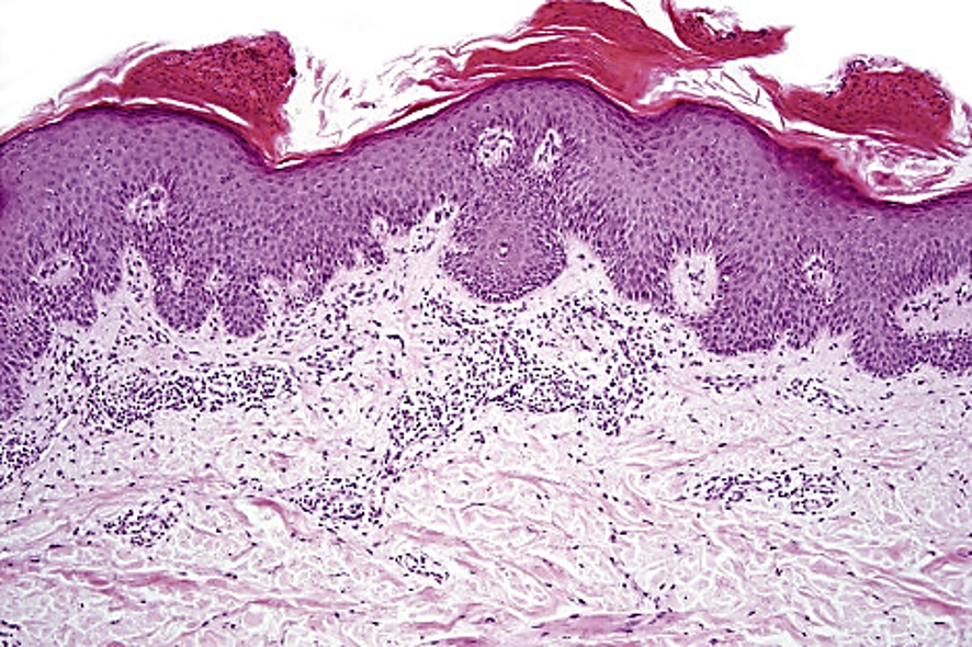 <p>TYPE 4 HYPERSENSITIVITY</p><p>inflammation is mediated by TH17 cytokines - causes destructive skin plaques</p>