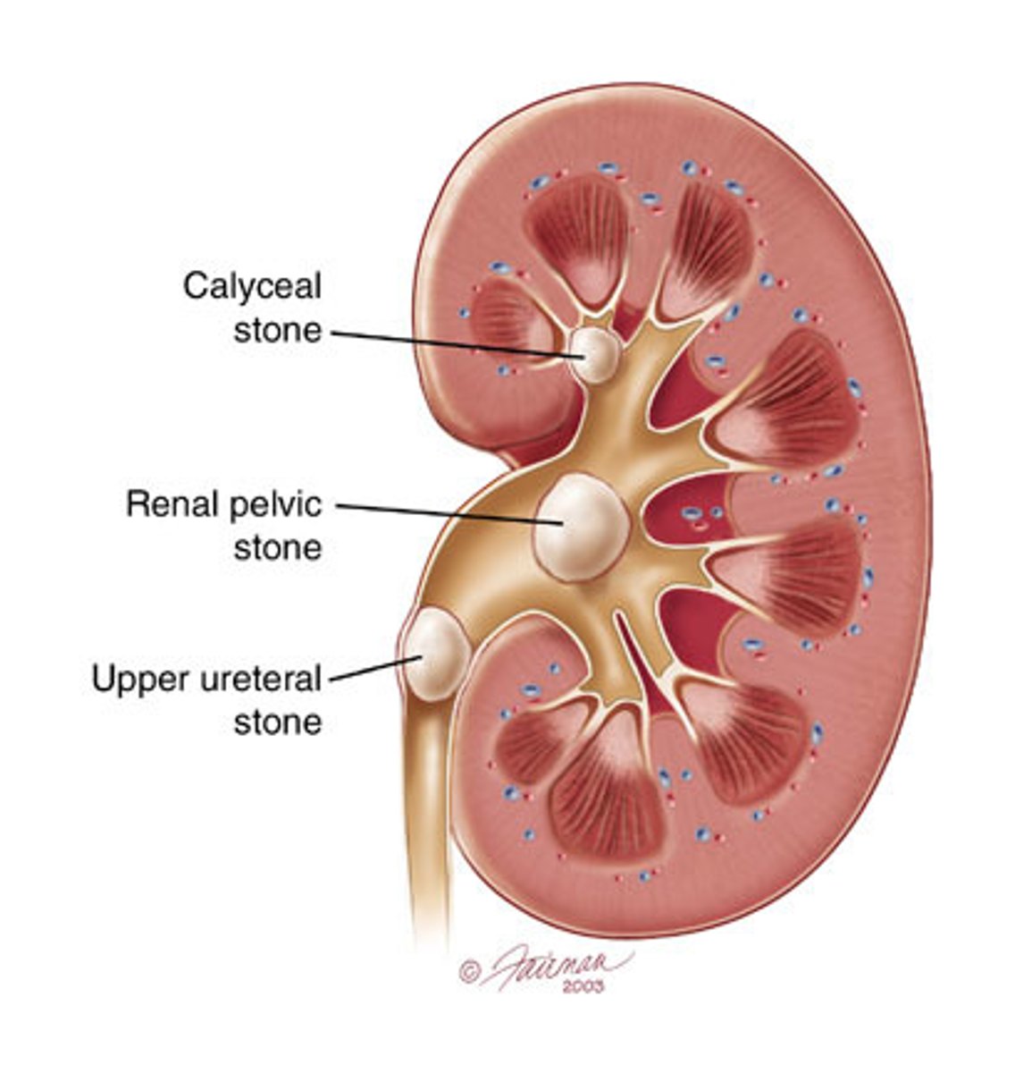 <p>Hypercalcemia and Hyperphosphatemia --> Kidney stones (calcification of soft tissues, kidney, lungs, heart, etc)</p>