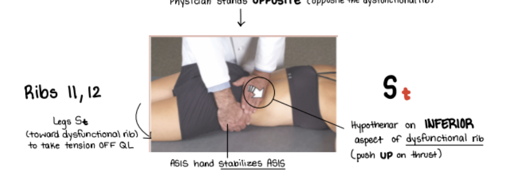 <p>Get patient on stomach</p><ul><li><p>Get legs to go bye.&nbsp; I is BYE</p></li><li><p>Localize rib 11 or 12 and place hypothenar on inferior aspect of dysfunctional rib</p></li><li><p>Use other hand to stabilize ASIS</p></li><li><p>Use hand on rib 11 or 12 to thrust caudad.</p></li></ul><p></p>