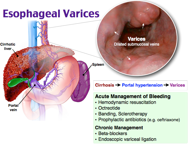 <p>huge, <span style="color: rgb(25, 144, 146);"><strong><span>fragile veins in esophagus</span></strong></span> caused by <span style="color: rgb(251, 53, 53);"><strong><span>portal HTN</span></strong></span></p><ul><li><p>bleeds easily → life threatening</p></li><li><p><strong>Portal hypertension</strong> = elevated BP  in veins carrying blood from intestines to liver</p></li></ul><p></p>