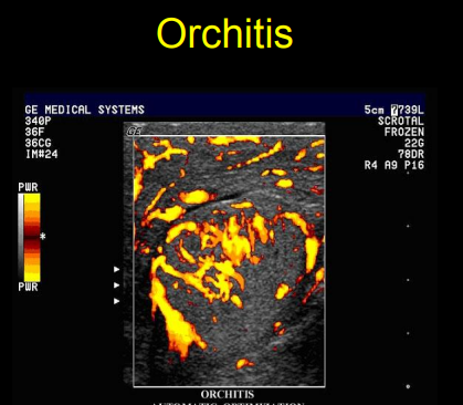 <p>Male repo disease on Ultrasound</p>