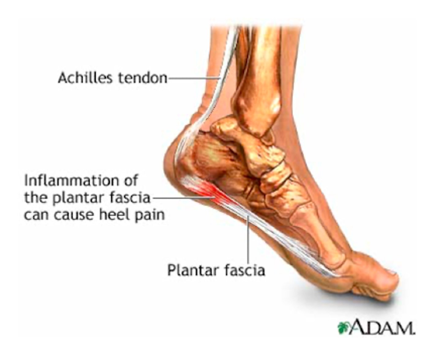 <p>heel pain</p><p>- will be tender upon palpation</p>