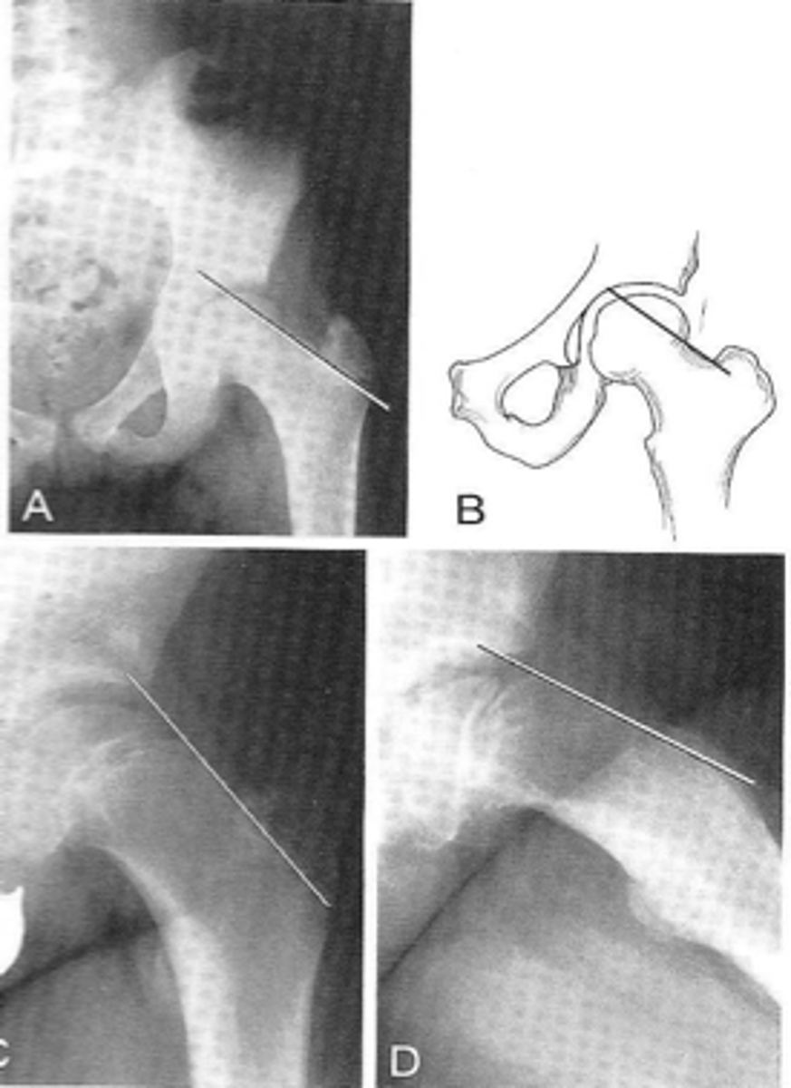<p>Clinical significance of Klein's line</p>