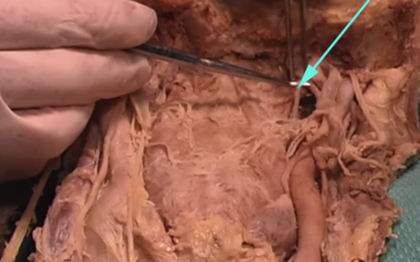 <p>Which nerve is this to which the arrow is pointing?</p><p>-Cranial nerve X (10)</p><p>-Cranial nerve XI (6)</p><p>-Cranial nerve XI (11)</p><p>-Cranial nerve IX (9)</p>