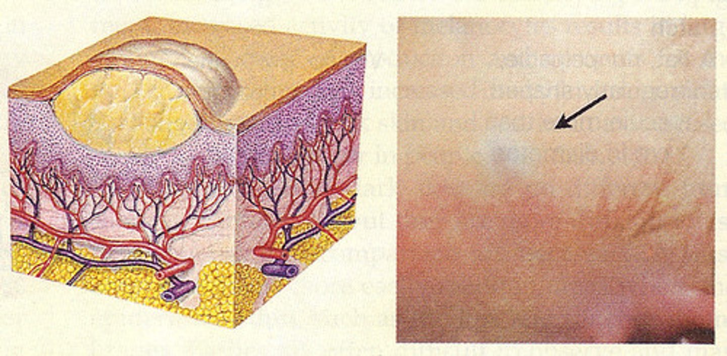 <p>Solid Mass can extend into the epidermis</p>