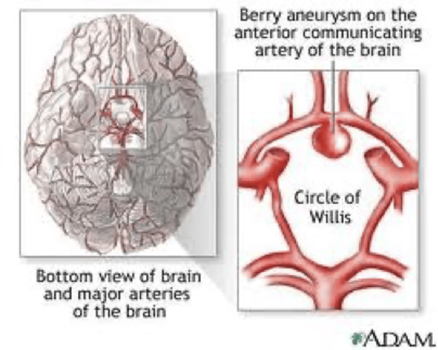 <p>-Normal hemodynamic stresses<br>-HTN<br>-Coarctation of aorta<br>-Atherosclerosis<br>-Smoking</p>