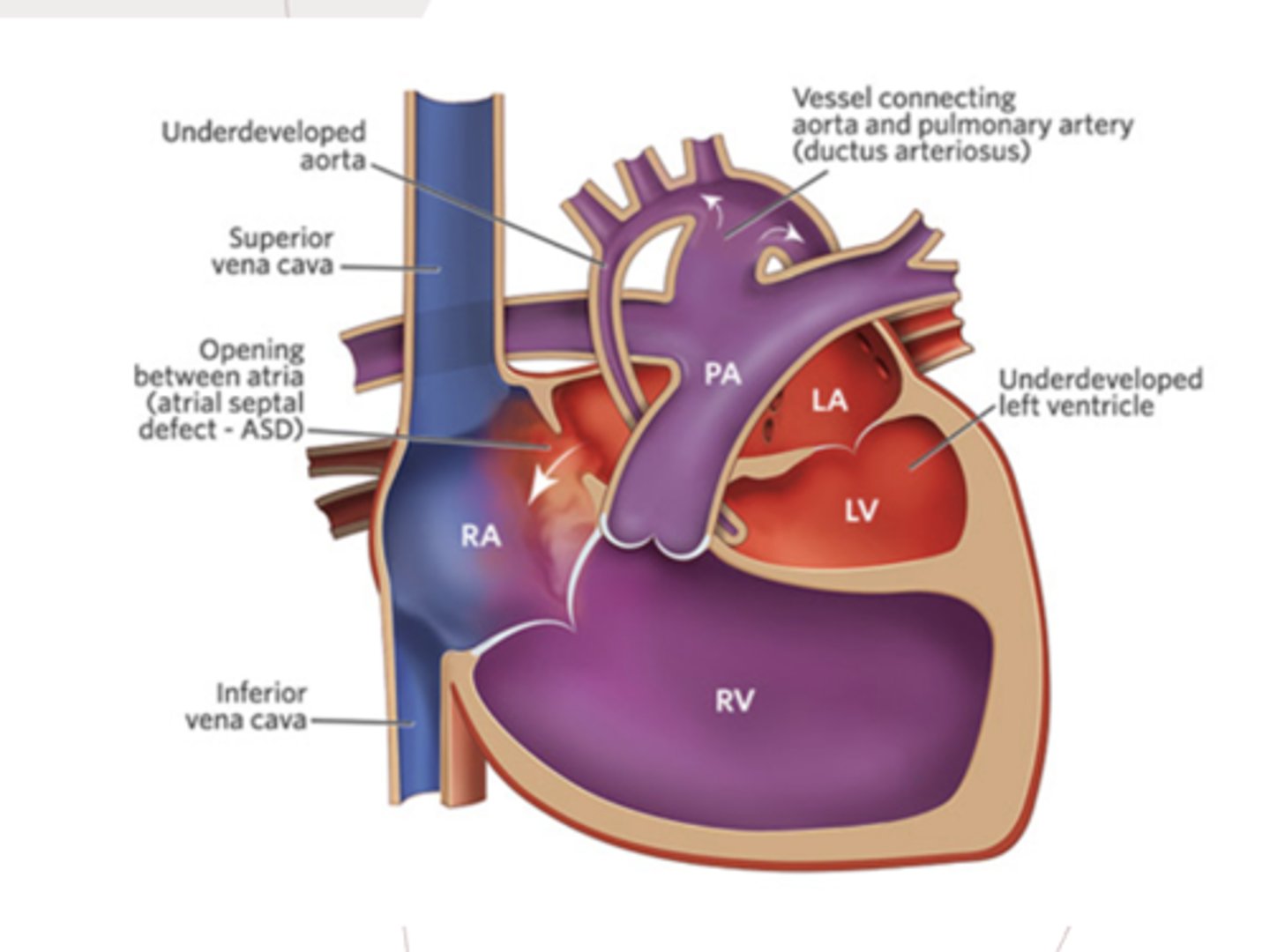 <p>Underdevelopment of the left side of the heart, resulting in a hypoplastic left ventricle and aortic atresia</p>