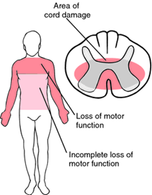 <ul><li><p>Damage to central cord</p></li><li><p>Most commonly occurs in the cervical region </p><ul><li><p>Neck hyperextension</p></li></ul></li><li><p>More common in older adults w/ degenerative disease</p></li><li><p>Motor weakness + altered sensation in upper extremities</p></li><li><p>Lower extremities usually not affected</p></li></ul><p></p>