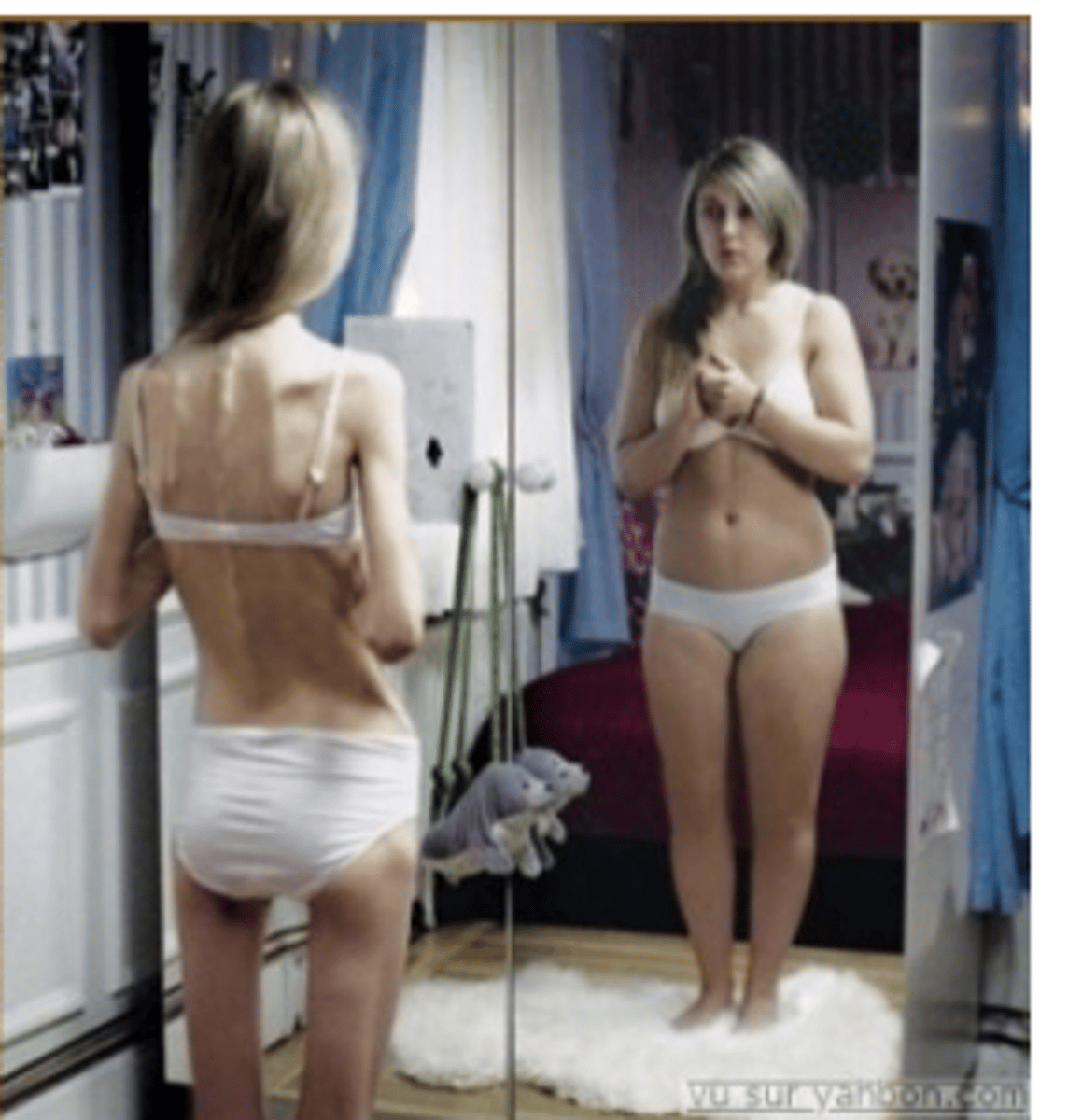 <p>abnormal eating patterns that do not meet the criteria for an eating disorder diagnosis</p><p>-- ARFID (Avoidant/Restrictive Food Intake Disorder) avoid certain foods or restrict their diets; often seen in children</p><p>-- Night eating syndrome (NES) - eat more than 25% of calories at night, have trouble sleeping, wake up at night to eat</p>
