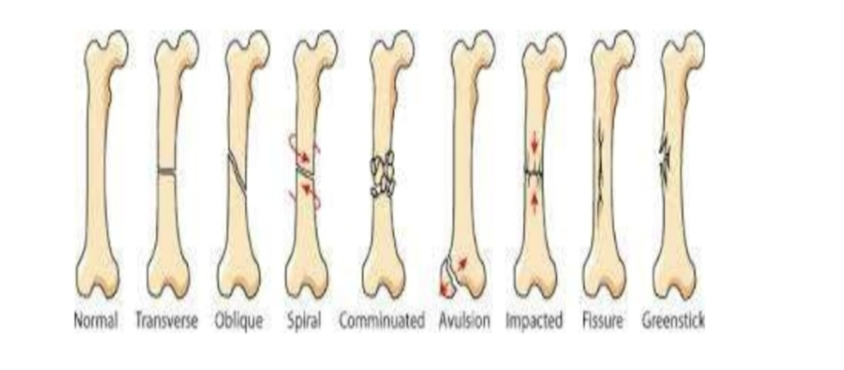 \
Comminuted- more than three pieces

Compression- the bone is crushed from impact, common in vertebrae

Spiral- occurs when excessive torque is placed on the bone Epiphysis- fractures involving the epiphyseal plate I-V. SALTER Harris 

Depressed- depression of piece of skull from blunt force

Greenstick or Incomplete- happens in young soft bone in which the bone bends but does not completely break (calf and cattle guard) 

Impaction- occurs when one piece of bone is forced down the center of the opposing piece (telescope)

Avulsion- piece of bone that is connected to a tendon/ligament which is torn off the main bone