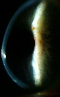 <p>0.04% to 0.06%</p><ul><li><p>vast majority are LASIK cases</p></li><li><p>why surgeons like to evaluate corneal thickness and biomechanics pre-operatively to avoid this</p></li></ul>