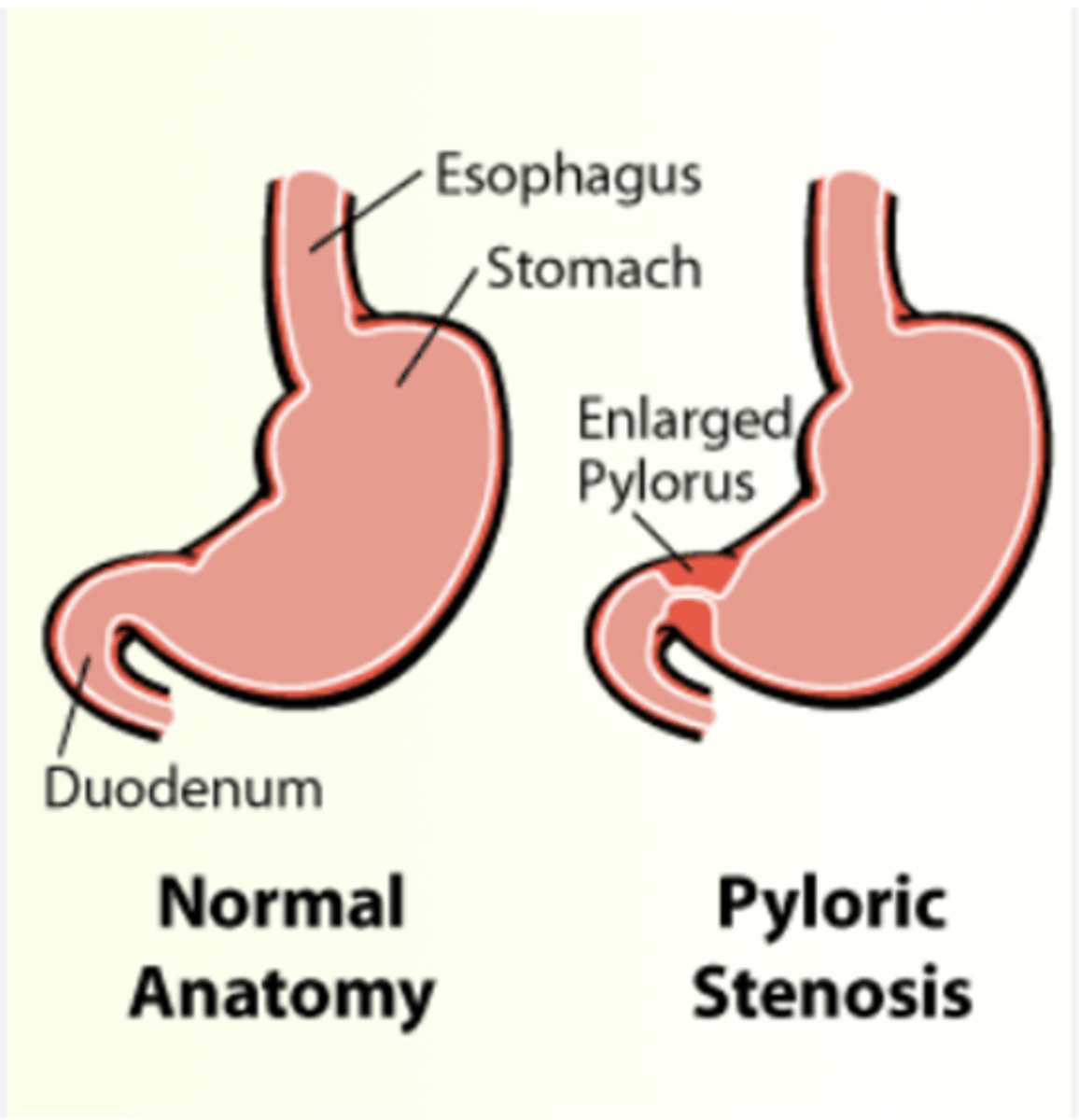 <p>Why is pyloric Stenosis "as infantile hypertrophic pyloric stenosis (IHPS)" ?</p>
