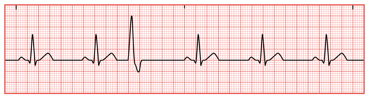 <p>PVCs can be normal and may occur often in healthy clients.</p>