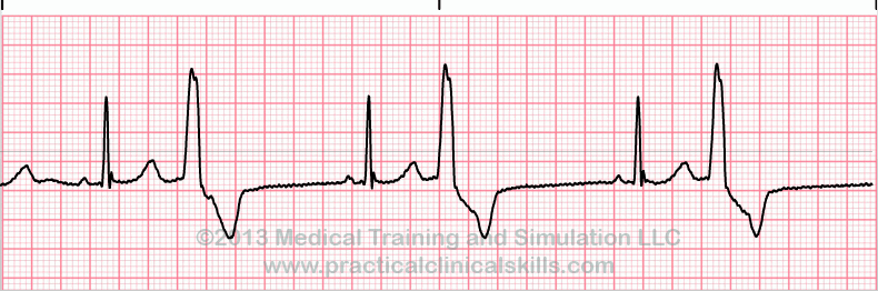 <ul><li><p>atrial rhythm is regular</p></li><li><p>ventricular rhythm is irregular</p></li><li><p>QRS complex is premature, wide, and/or distorted (&gt;0.14 seconds)</p></li><li><p>premature QRS complexes occur in singles, pairs, or groups of 3 </p></li></ul><p></p>