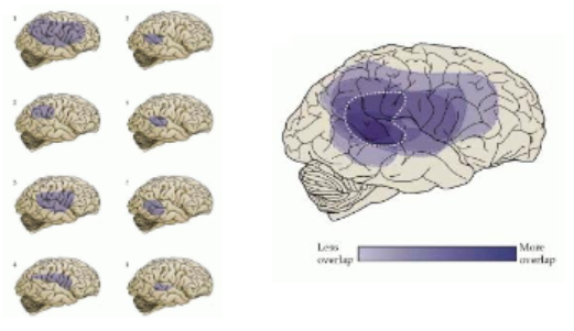 <p>Heterogeneity of brain regions implicated, and the extent of lesions varies extensively </p>