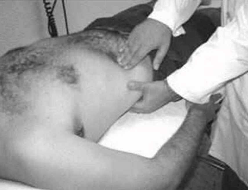 <p>El paciente en decúbito dorsal y en completa relajación muscular, con las piernas, extendidas o muy ligeramente flexionadas, con los talones de los pies, apoyados en la cama, el médico se sitúa en el lado del riñón que se palpa, viendo hacia la cabeza del paciente.</p><p>Una <strong>mano de sostén</strong> (Mano izquierda para palpar el riñón derecho) apoyando su doroso sobre la cama y perpendicular a la línea media, <strong>deprime la región lumbar</strong>.</p><p>La otra <strong>mano activa </strong>(Mano derecha que uno de los dedos suavemente) se aplica en la cara anterior del abdomen, con su eje mayor paralelo a la línea media y por fuera de los músculos rectos anteriores.</p><p>El paciente respira tranquilamente.</p><p>La palpación se comienza desde la fosa iliaca.</p><p>Se <strong>hunden suavemente los dedos de la mano activa</strong>, durante la inspiración, y se avanza hacia arriba durante la espiración, sin despegar los dedos de la pared abdominal.</p><p>Se deprime con la mano de sostén solo al final de la inspiración.</p>