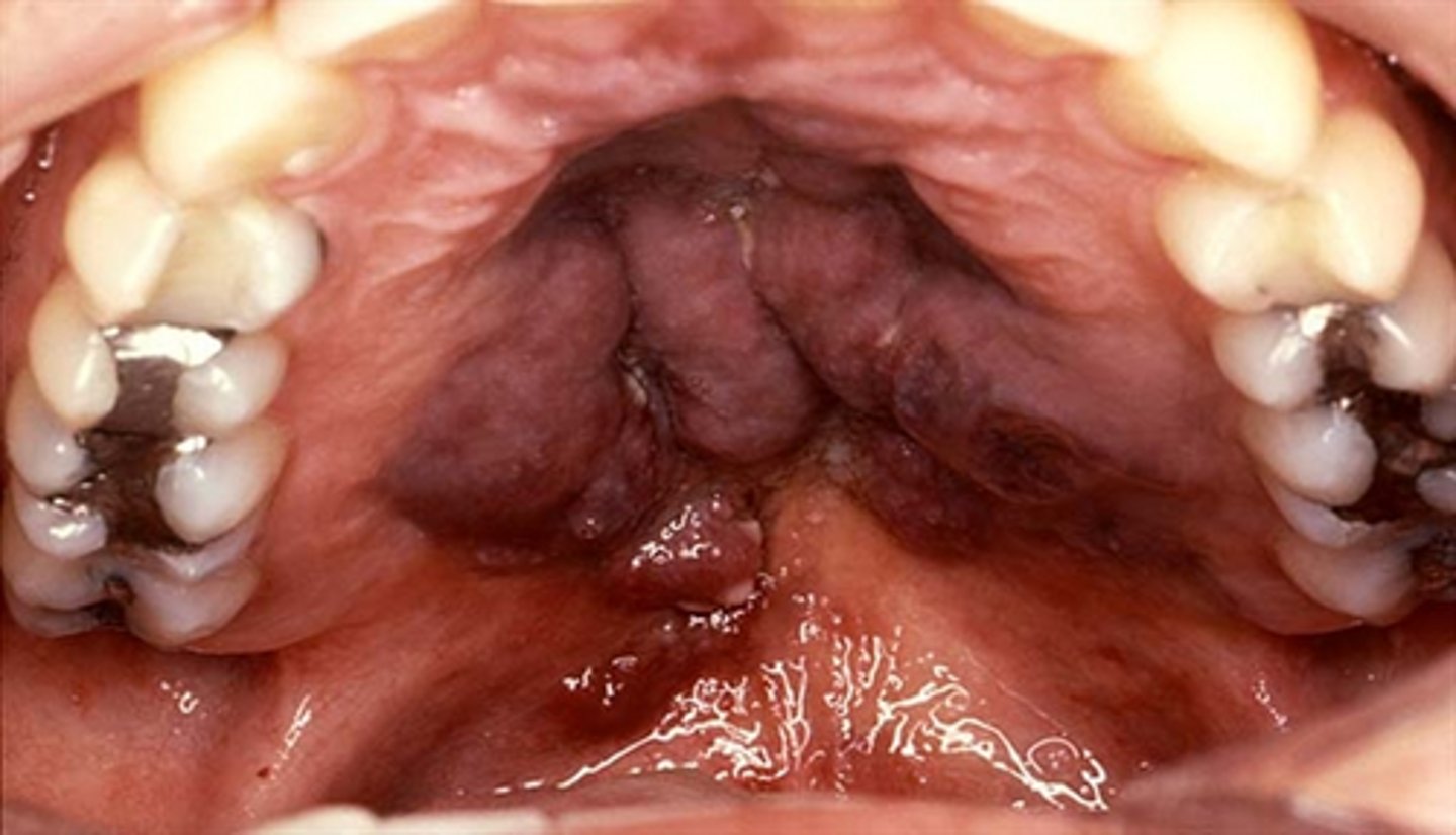 <p>A lesion appears purple on the palate and does not blanch or resolve over time. The patient has a history of HIV.</p><p>What is the most likely diagnosis?</p>