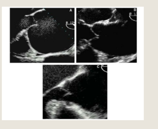 <p>Acquired Root Dilatation may occur in different parts of the aorta.</p><p>Idiopathic describes a disease of unknown cause</p>