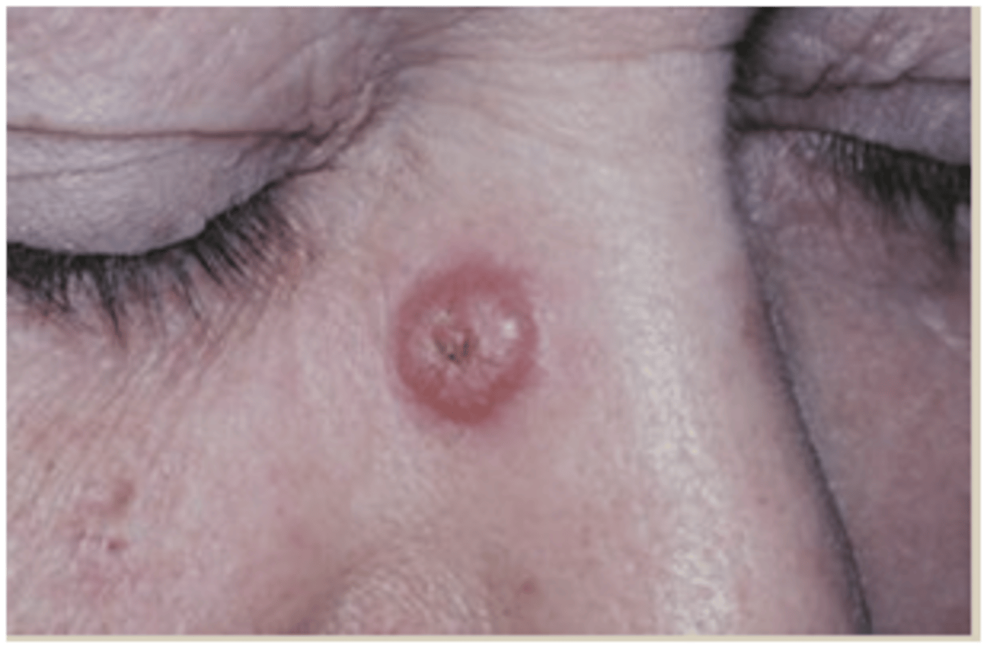 <p>A pre-cancerous lesion that is a fast growing nodule that develops within weeks to 1-2 months</p><p>Associated with SCC</p>