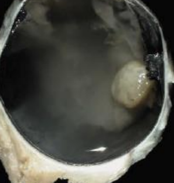 <p>What is the term for a small lens? Aphakia refers to an absent one.</p>