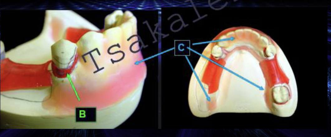 <p>what type of blockout is B</p>