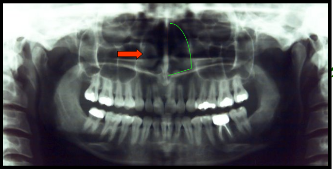 <ul><li><p><span>Appears as a large radiolucent area superior to the maxillary incisors divided into two compartments or fossa</span></p></li><li><p><span>Appears as a vertical radiopaque partition that divides the nasal cavity</span></p></li><li><p><span>Appears as diffuse radiopaque masses or projections within the nasal cavity.</span></p></li></ul><p></p>