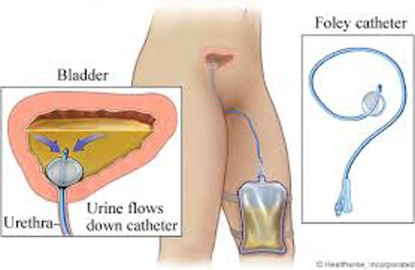 <p>has a balloon near its tip that is inflated after insertion to hold the catheter in the urinary bladder for continuous drainage of urine.</p>