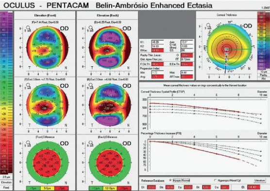 <p>belin-ambrosio enhanced ectasia display</p><ul><li><p>Anterior elevation at thinnest point</p></li><li><p>Posterior elevation at thinnest point</p></li><li><p>Change in anterior elevation</p></li><li><p>Change in posterior elevation </p></li><li><p>Corneal thickness at thinnest point </p></li><li><p>Location of thinnest point </p></li><li><p>Pachymetric progression </p></li><li><p>Ambrosio relational thickness </p></li><li><p>Kmax</p></li></ul>