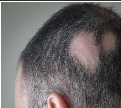 <p>Loss of hair from the scalp due to disease, medication, or changes in hormone levels.</p>