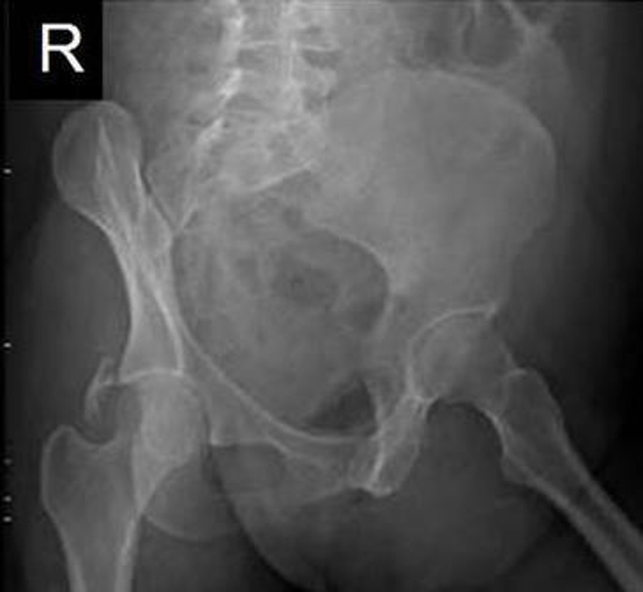 <p>Other Pelvic Views: <strong>______________</strong></p><p></p><p>o Evaluate posterior wall of acetabulum</p>