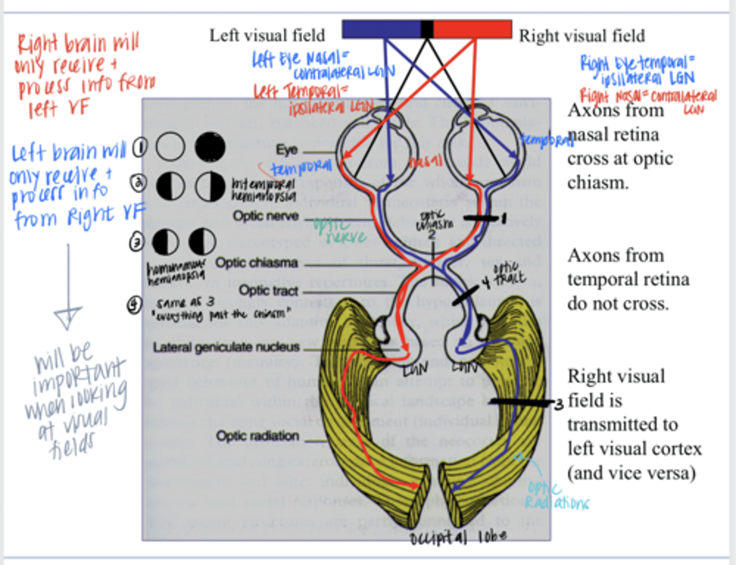 <p>If there was an injury that completely severed the R optic nerve, what would the corresponding VF look like?</p>