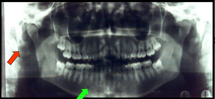 <ul><li><p><span>appears as a small, ovoid or round radiolucency located in the apical region of the mandibular premolars.</span></p><ul><li><p><span>This landmark can be seen in intraoral images.</span></p></li></ul></li><li><p><span>appears as a radiopaque shadow posterior to the condyle.</span></p><ul><li><p><span>This landmark is not visible on intraoral images.​</span></p></li></ul></li></ul><p></p>