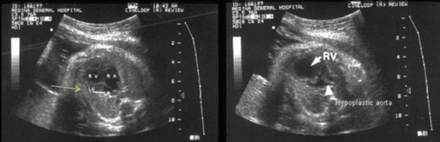 <p>Most common cause of death from heart disease during the neonatal period</p><p>Failure for LV to develop - left side of heart is small or absent</p><p>Small LV Little color flow through MV</p><p>Small AO</p><p>Reversed flow through foramen ovale and ductus arteriosus</p>
