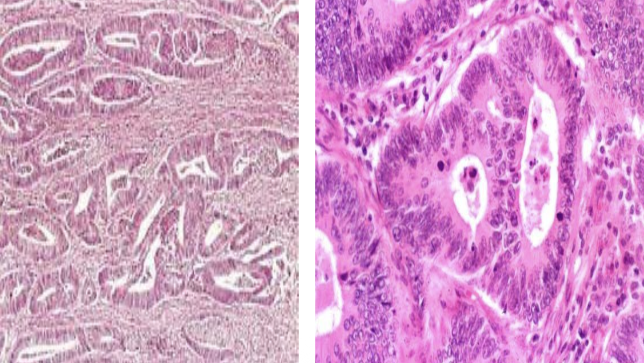 <p>Identify the <strong>organ</strong> and the <strong>diagnosis</strong> in this format: <em>diagnosis, organ</em></p>