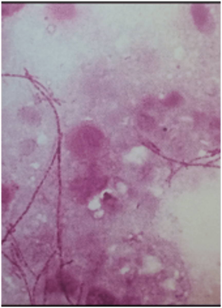 <p>what causative agent of liver abscesses is indicated in this image</p>