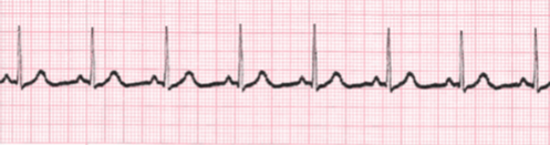<p>Describe the rhythm of this patient.</p>