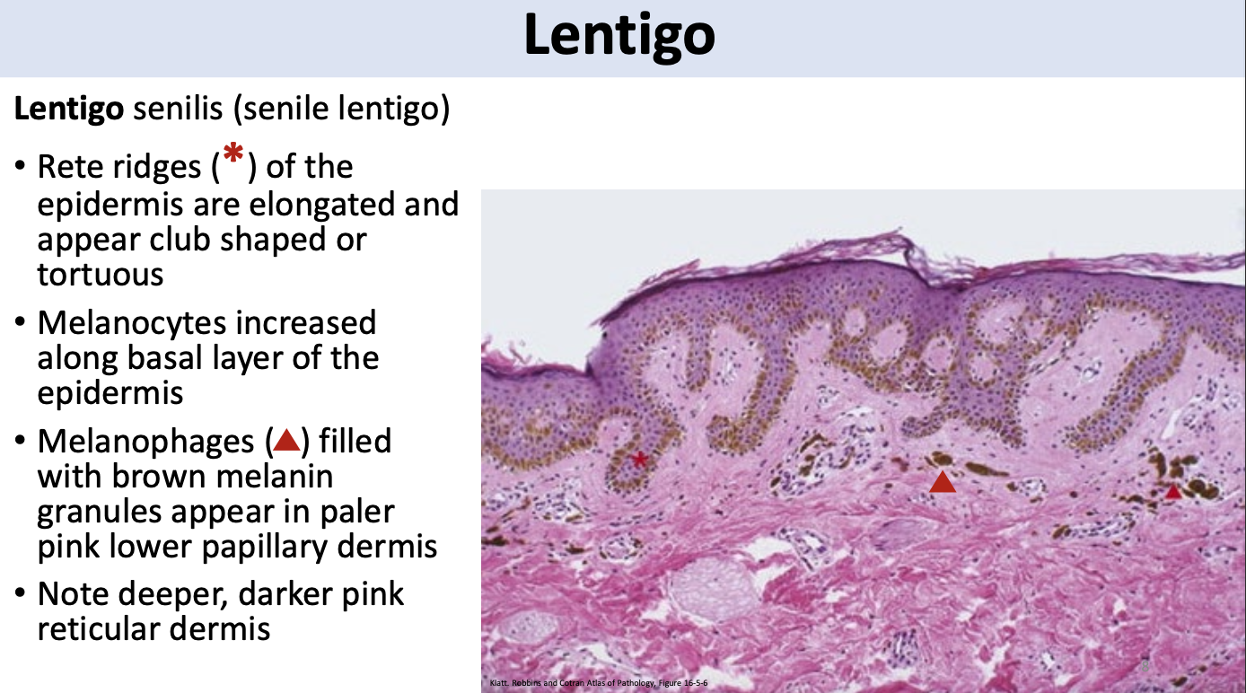 <p>senile lentigo (lentigo senilis) / liver spots / age spots / solar lentigo / actinic lentigo</p><p>hockey sticks/dirty socks</p>