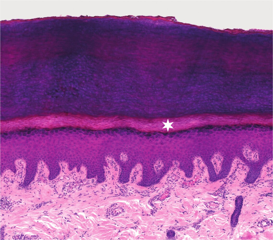 <p>16. In the image, a layer of the epidermis from thick skin (like on the palms or soles) is marked with a star. This layer mostly contains nucleus-free transitional stages between keratinocytes and fully formed horn cells (corneocytes).</p><p>Which layer is it?</p><p>A. Stratum basale</p><p>B. Stratum corneum</p><p>C. Stratum granulosum</p><p>D. Stratum lucidum</p><p>E. Stratum spinosum</p>