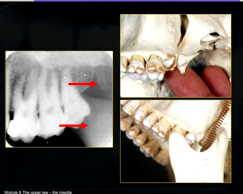 <ul><li><p>pterygoid hammulus - supports the muscles of the soft palate </p></li><li><p>coronoid process of the mandible </p></li></ul><p></p>