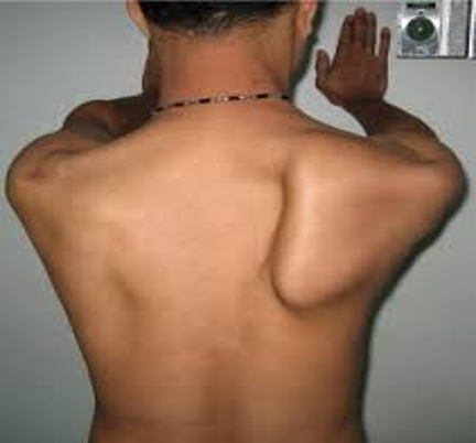 <ul><li><p>CN XI dysfunction</p></li><li><p>have pt perform a wall pushup → scapular instability makes inferior border of scapula move medially or laterally</p></li><li><p>medial- serrates anterior muscle weakness </p></li><li><p>lateral- trapezius muscle weakness</p></li></ul><p></p>