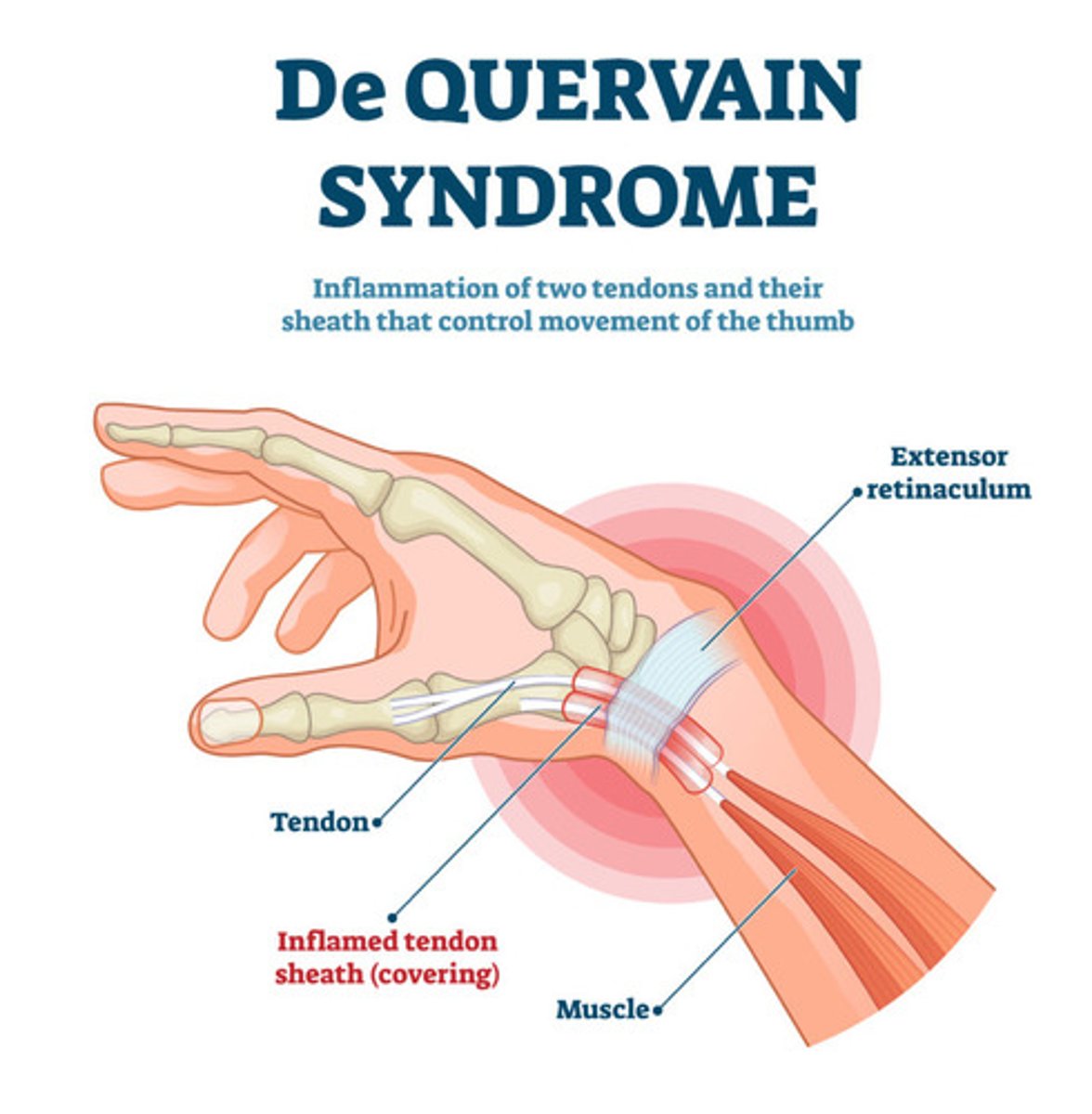 <p>tenosynovitis of abductor pollicus longus and extensor pollicus brevus</p>
