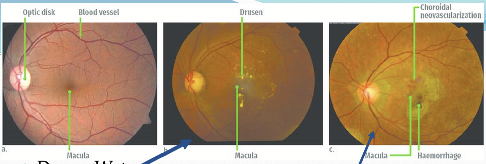 <ul><li><p>Dry: </p><ul><li><p>early-intermediate : fuzzy/distorted vision</p></li><li><p>advanced: loss of RPE in macular region: leads to loss of photoreceptors central vision loss </p></li></ul></li><li><p>Wet: advanced neovascular stage </p><ul><li><p>growth of choroidal vasculature into normally avascular sub-RPE and suv-retinal regions </p></li><li><p>loss of more RPE/photoreceptors/central vision </p></li></ul></li></ul><p></p>