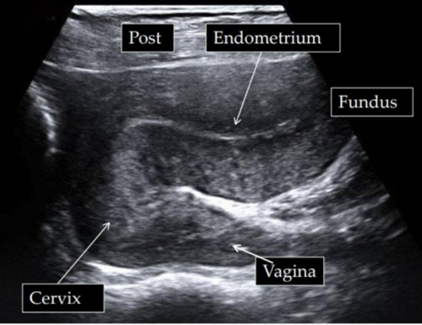 <p>Anteverted and anteflexed</p>