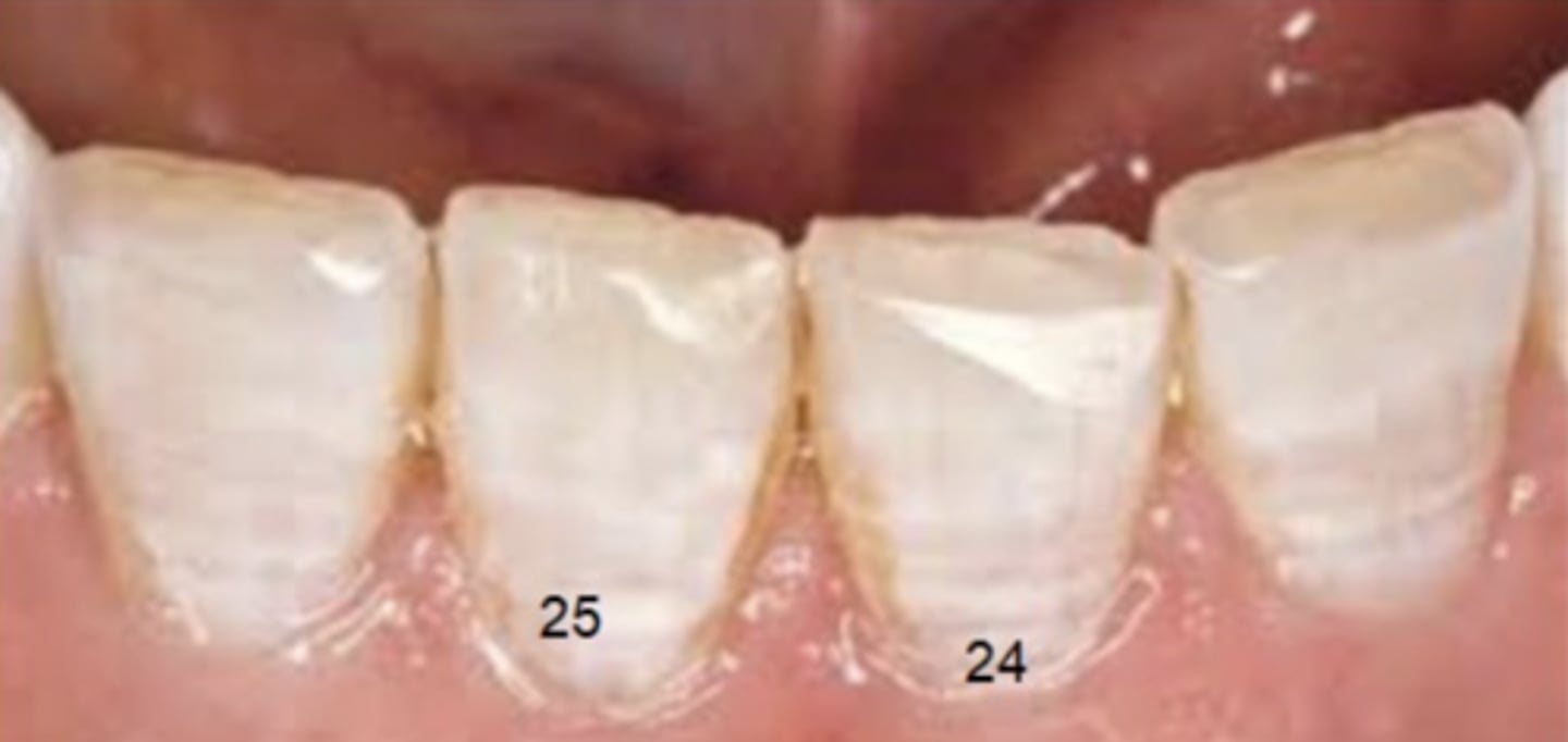 <p>Wear if the incisal edge</p>