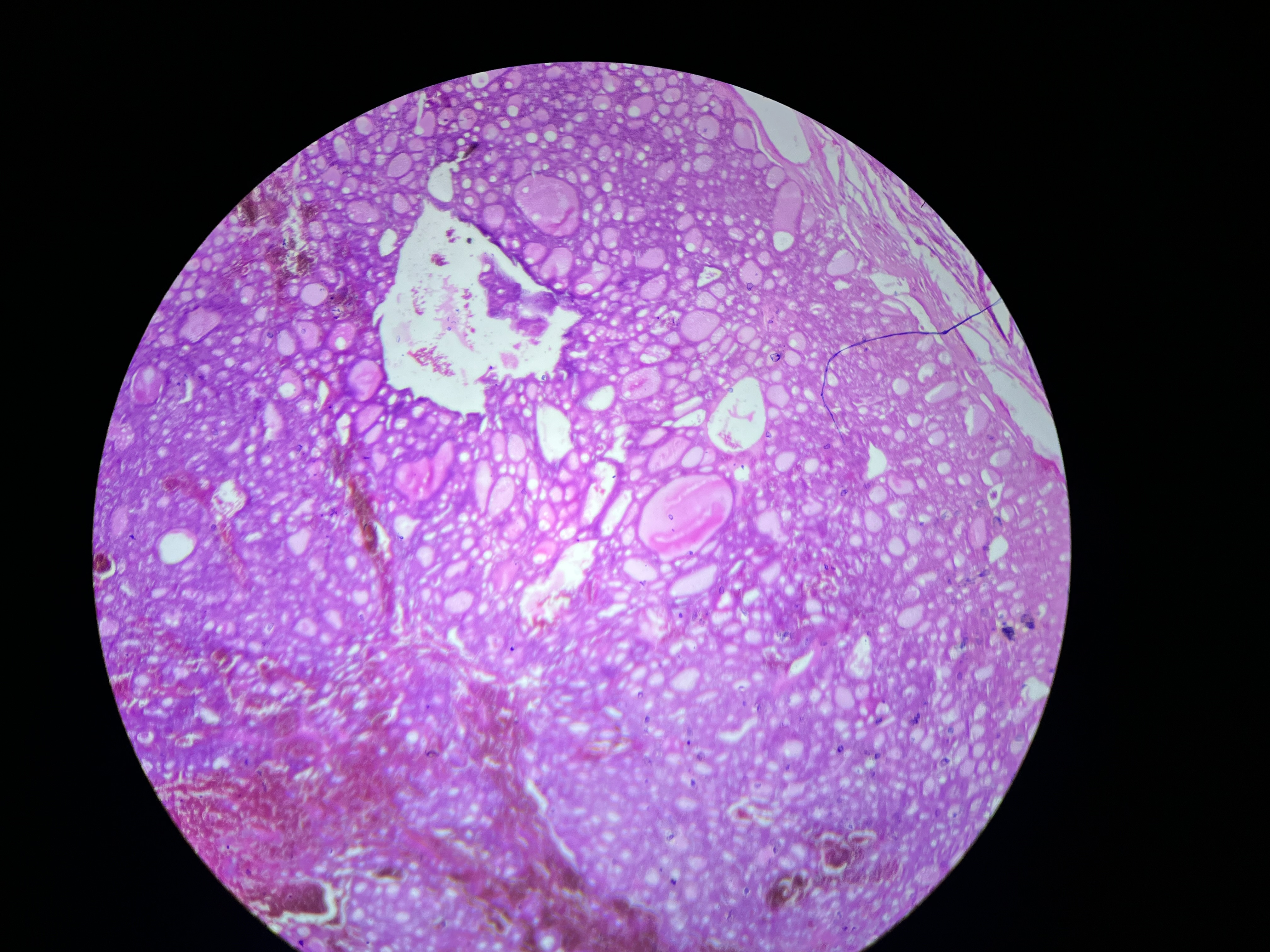 <p>A benign tumor of the thyroid gland is characterized by the proliferation of follicular cells, <span>associated with increased levels of thyroglobulin due to the active follicular cell proliferation.</span></p>