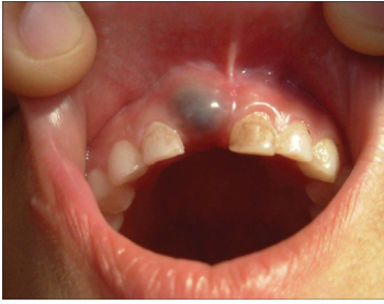 <p>-eruption cyst where blood fills the follicular space</p>