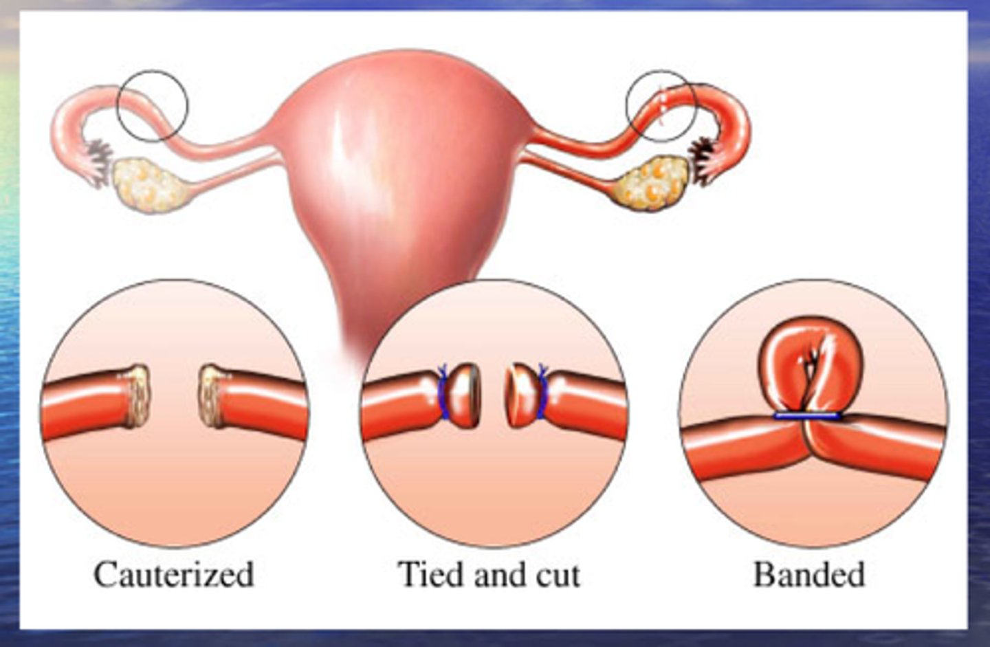 <p>closure of the fallopian tubes for sterilization</p>
