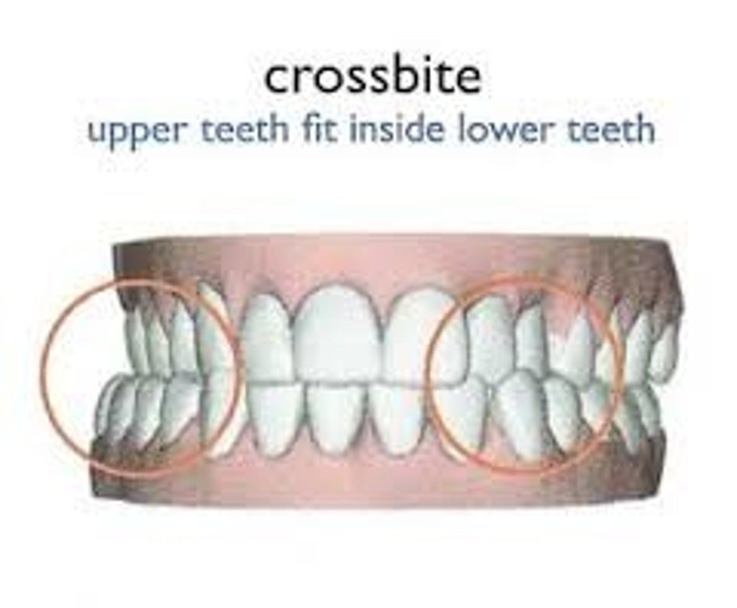 <p>Maxillary teeth are lingual to mandibular teeth</p>