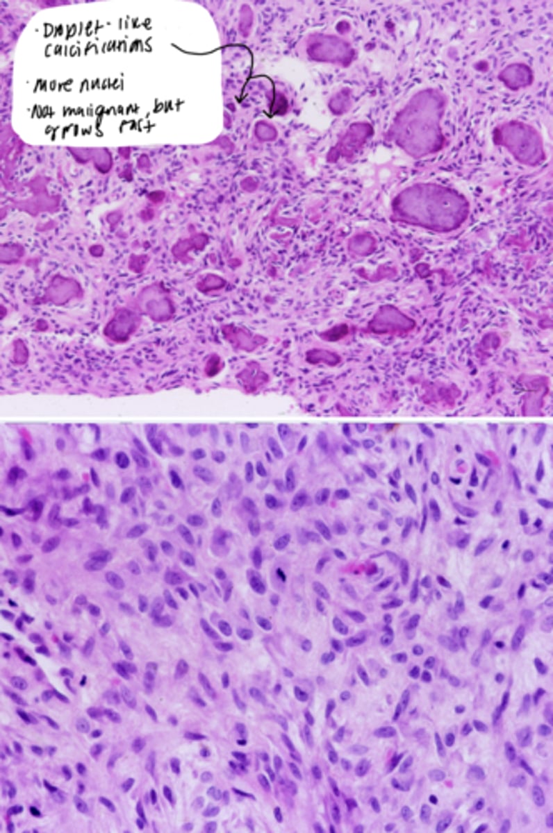 <p>- Droplet-like calcifications</p><p>- More nuclei</p><p>- Not malignant but grows fast</p>