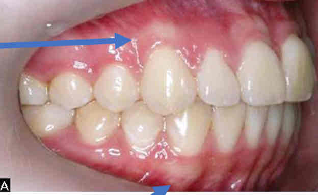 <p>protruding bony ridge above the maxillary canine and below he mandibular canine </p><ul><li><p>bulge in the alveolar process (tooth socket) bone that covers the root of the canine</p></li></ul>